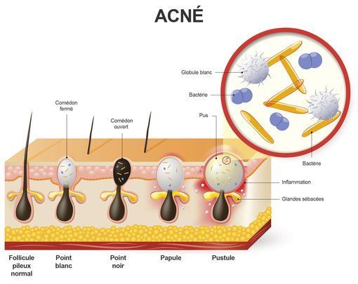 Schéma des différentes type de lésions d'acné (comédon, papules, pustules, nodules)