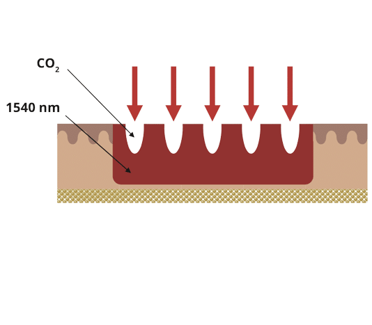 Schéma de l'action sur la peau du laser CO2 hybride DuoGlide DEKA