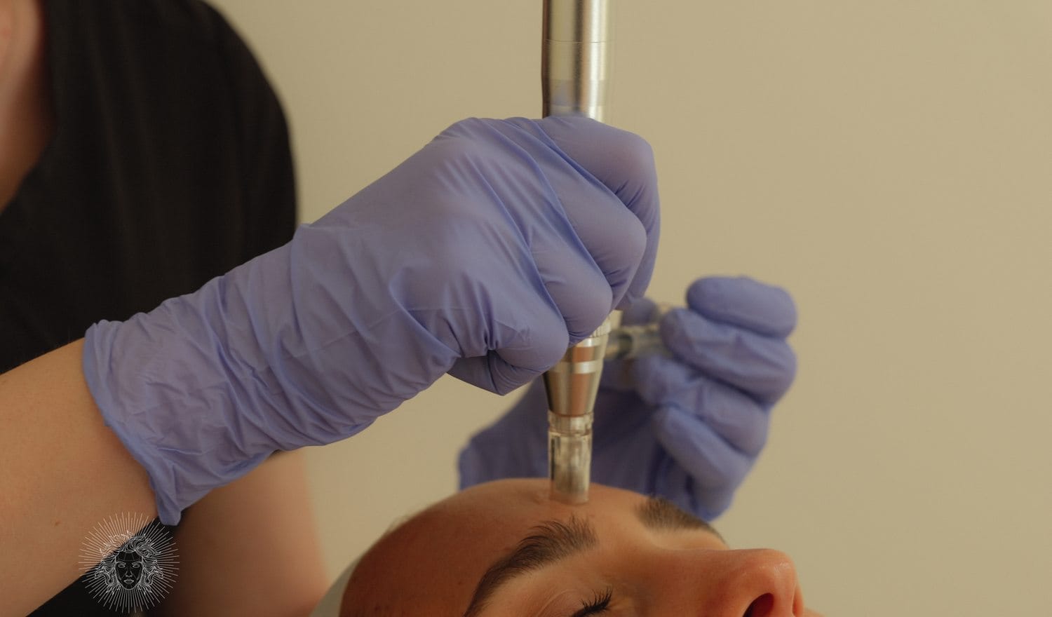 Microneedling esthétique du visage — Maison Andromède