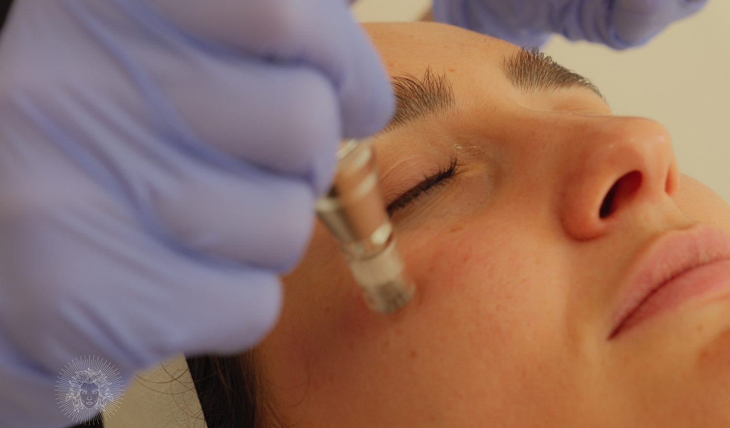 Microneedling, qualité de peau — Maison Andromède