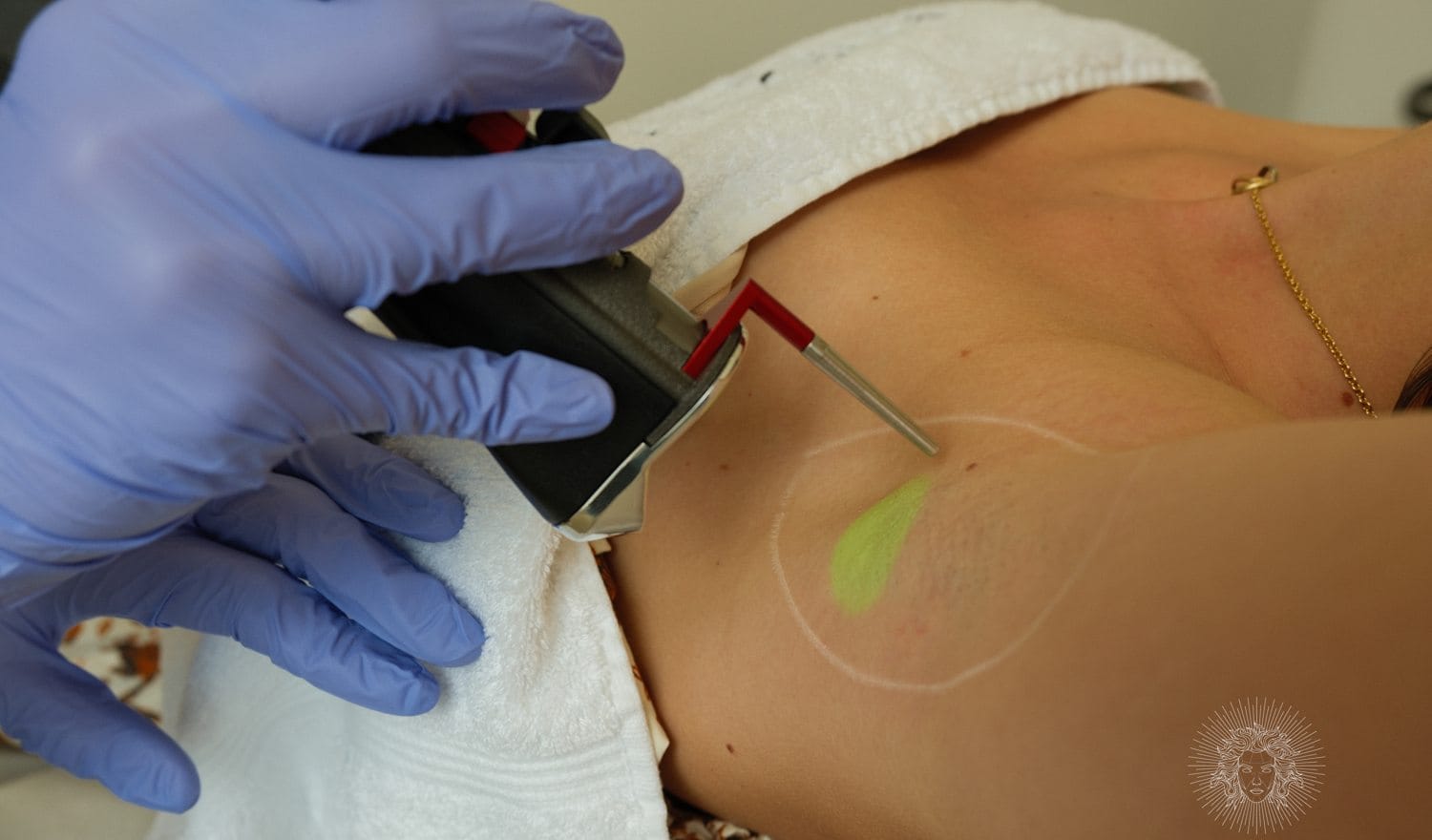 Séance d'épilation laser — Maison Andromède, Libournais