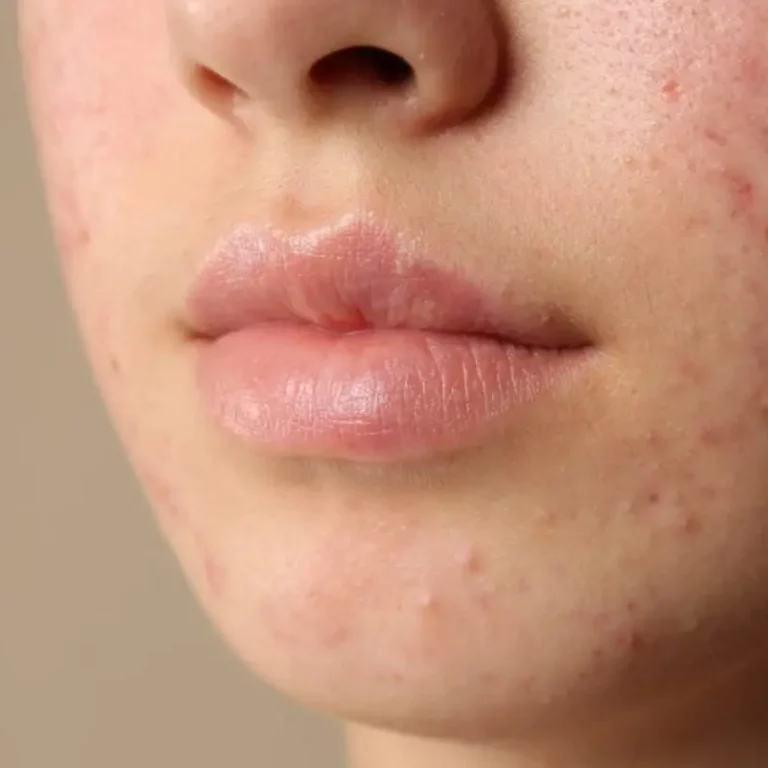 Acné à l’adolescence