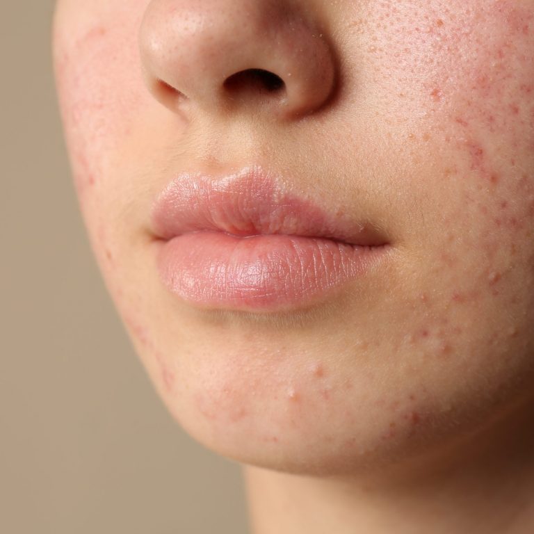 Teenage girl with acne problem on beige background, closeup